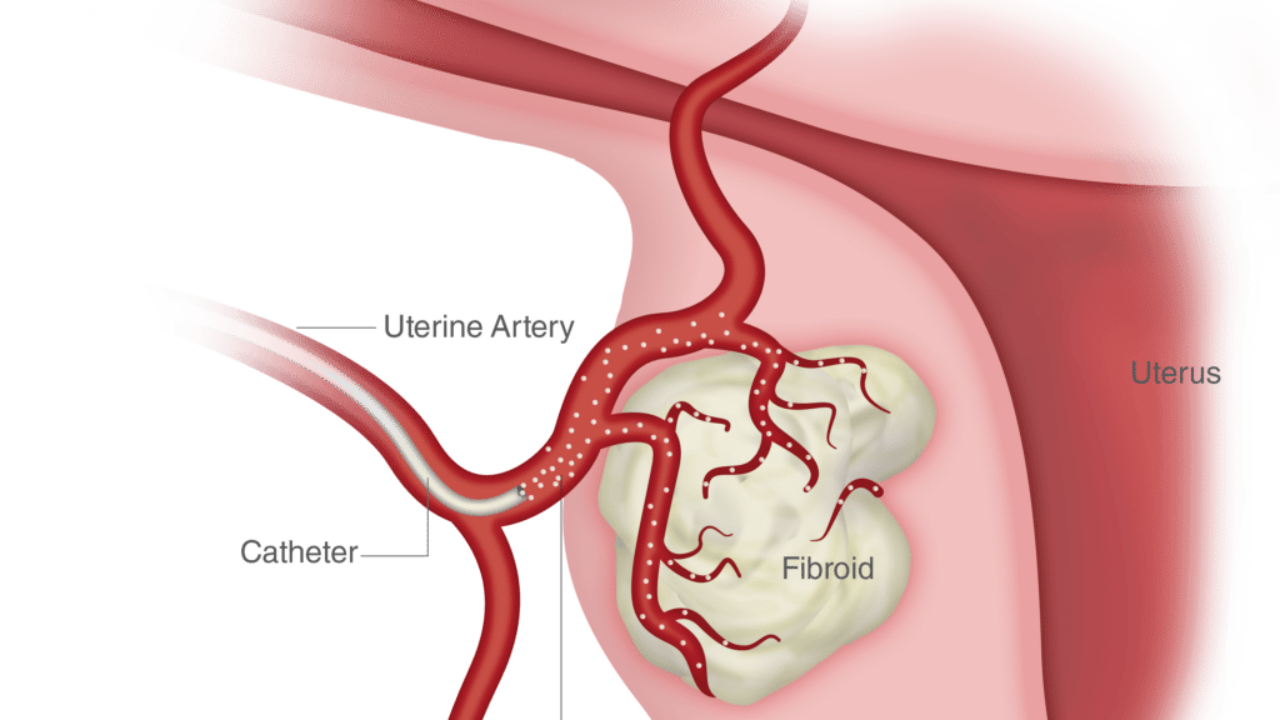 What Do Large Blood Clots During a Period Mean? - North Texas Fibroids