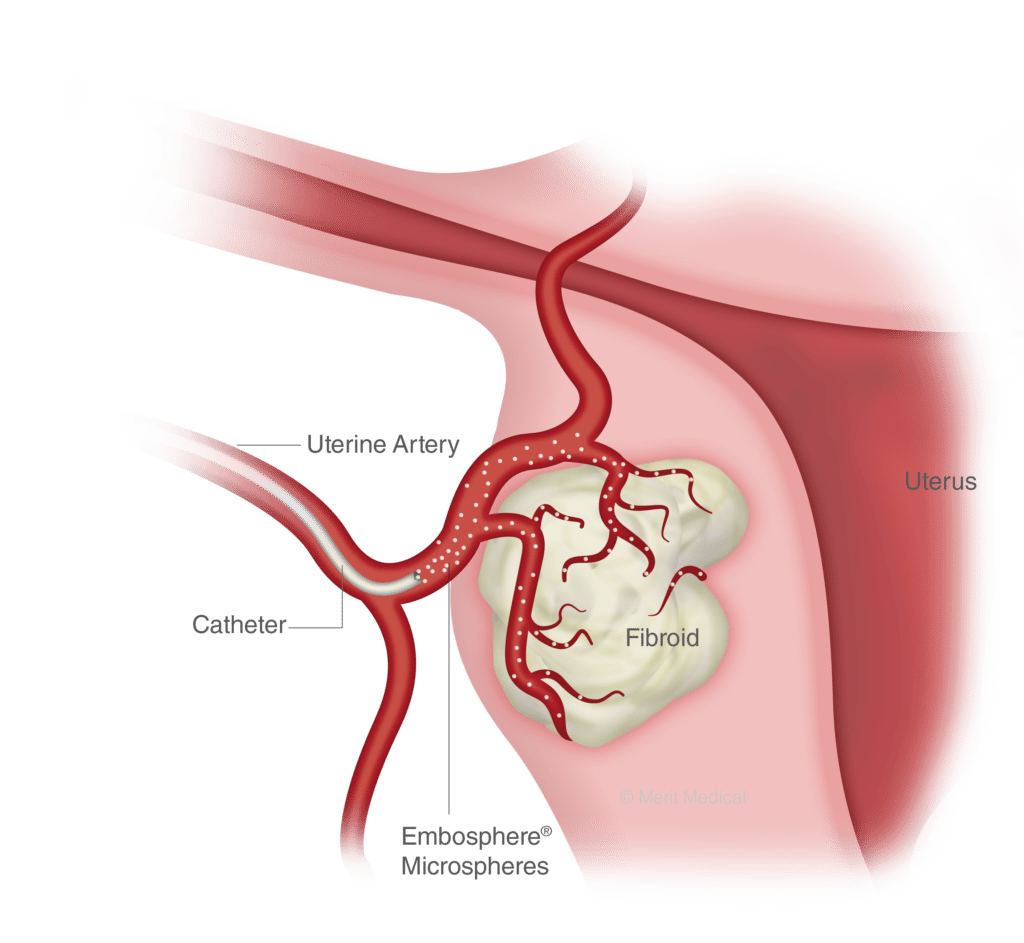 a-detailed-visual-of-the-internal-problems-of-uterine-fibroid-embolization