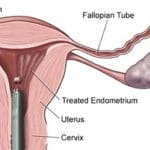 Fibroid Treatment