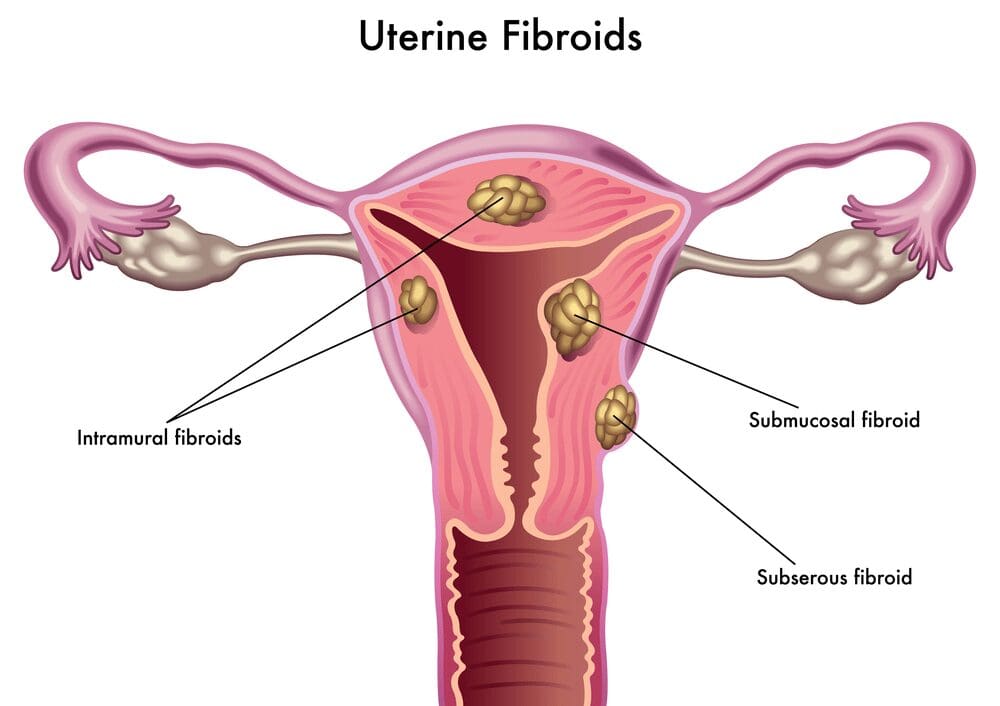 diagram-of-a-uterus-and-the-different-types-of-fibroids