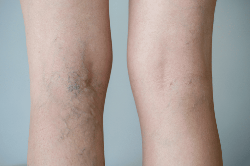 How Many Sessions of Sclerotherapy Are Typically Needed?