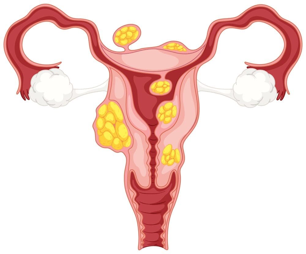 a-diagram-of-a-uterus-and-with-all-types-of-fibroids-on-and-in-the-uterine-wall