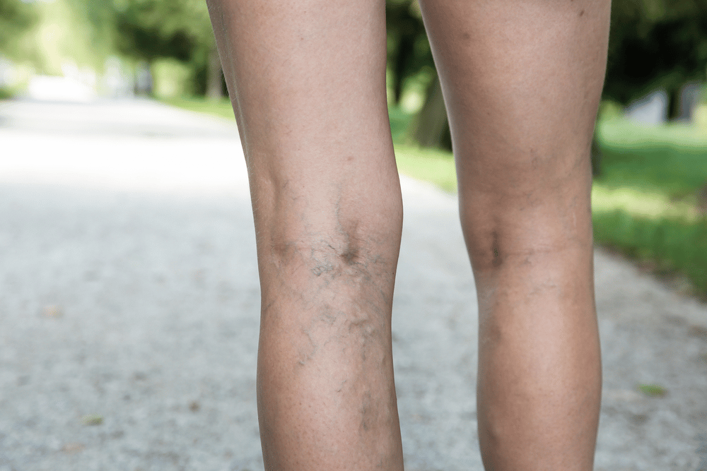 How Can You Treat Spider Veins on Your Legs?